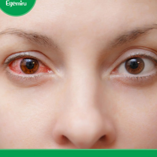 7 cách điều trị đau mắt đỏ tại nhà cực hiệu quả: https://www.eyemiru.net.vn/tips/7-cach-dieu-tri-dau-mat-do-tai-nha