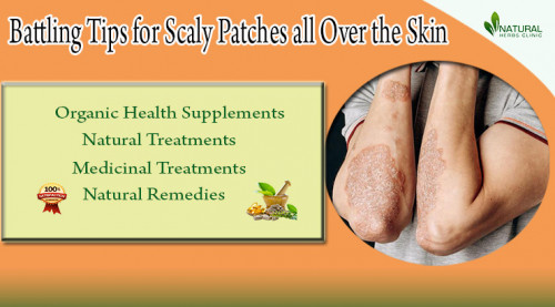 Struggling with unsightly Scaly Patches all Over the Skin? Get expert advice on prevention and treatment from a trusted source. https://www.naturalherbsclinic.com/blog/battling-scaly-patches-all-over-the-skin-experts-prevention-advice/