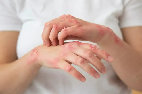 Struggling with Skin Disorders in Adults? Learn how to effectively manage symptoms and navigate the challenges with our helpful tips. https://www.fimfiction.net/blog/1030712/navigating-the-skin-disorders-in-adults-challenges-tips-for-managing-symptoms