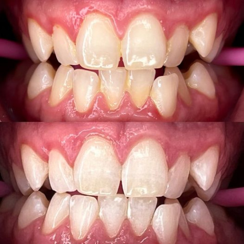 Teeth Whitening Cosmetic Tattooing Melbourne