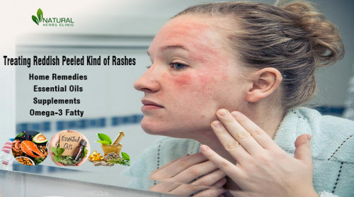 How to treat Reddish Peeled Kind of Rashes effectively with this essential guide for skin health. Get tips on prevention and Treatments. https://www.naturalherbsclinic.com/blog/treating-reddish-peeled-kind-of-rashes-essential-guide-for-skin/