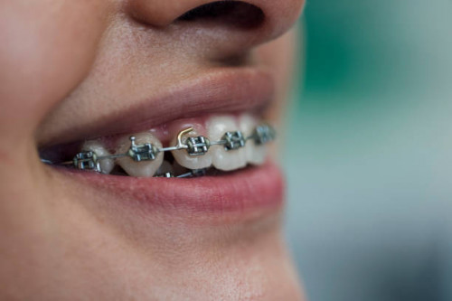 Finding affordable braces options in Middletown doesn’t have to be a challenge. We offer a variety of flexible payment plans and financing options to ensure that orthodontic treatment is accessible to everyone. 

Learn More- https://www.ocortho.net/treatments